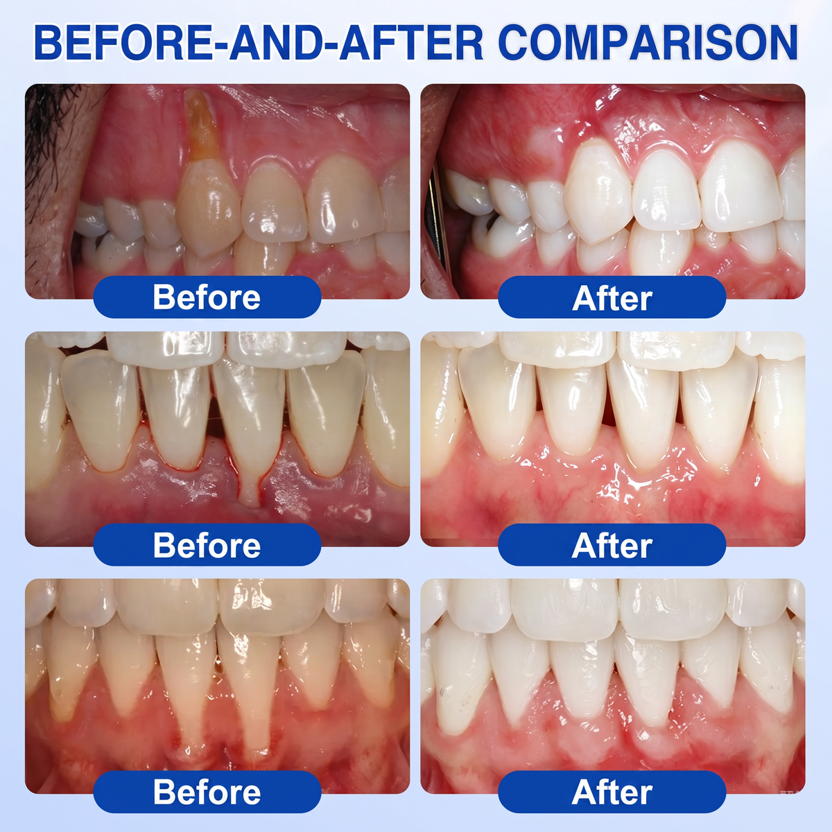 🦷Solaroza® GumRevive periodontal repair gel💧